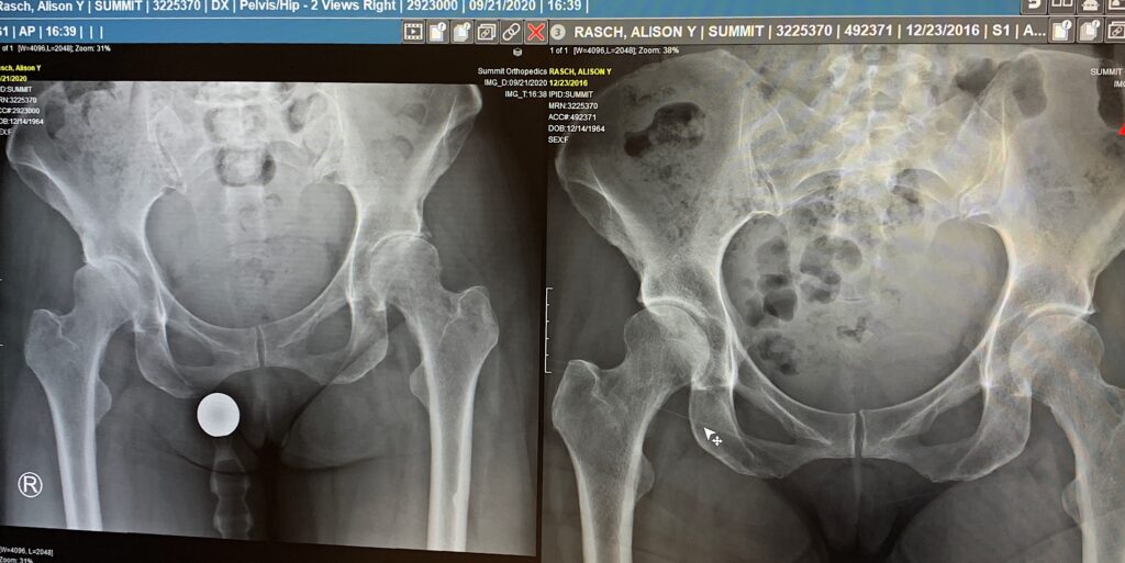 My hip looked a bit like a square peg being shoved into a round hole. 